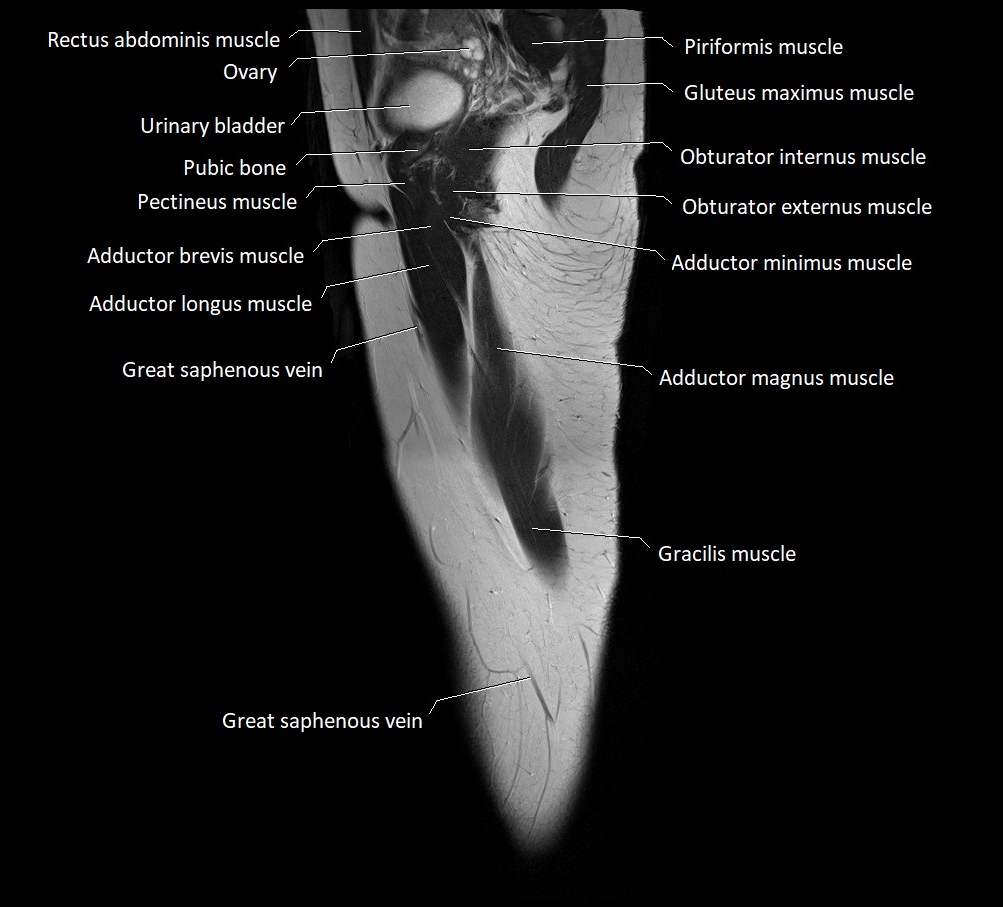 Thigh sagittal cross sectional anatomy MRI 3T image 19.webp